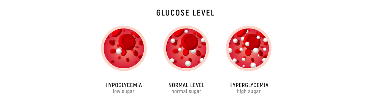 Low blood glucose: hypoglycemia or low blood glucose, normal level, hyperglycaemia or high blood glucose